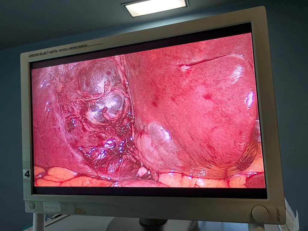 Liver cyst visible after gall bladder surgery