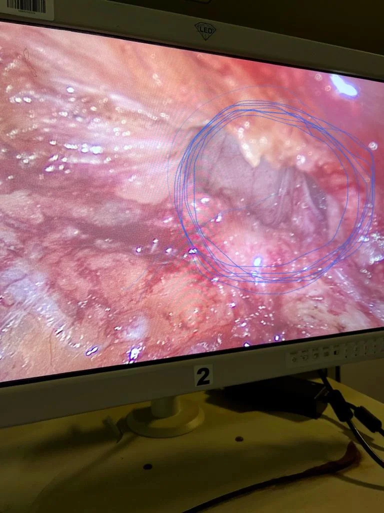 Hernia at umbilicus visible laproscopically