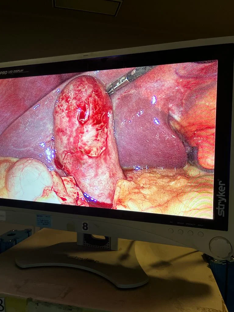 Hot and pus filled gall bladder due 