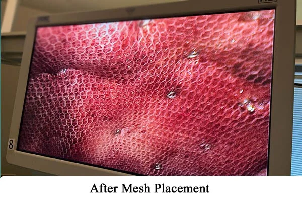 Hernia Repair by Robotics or by Laparoscopy