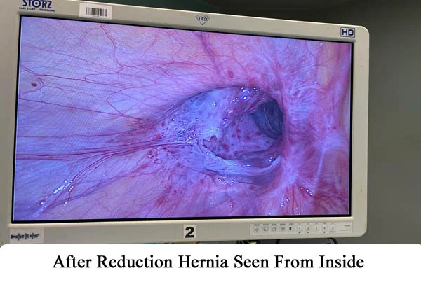 Hernia Repair by Robotics or by Laparoscopy