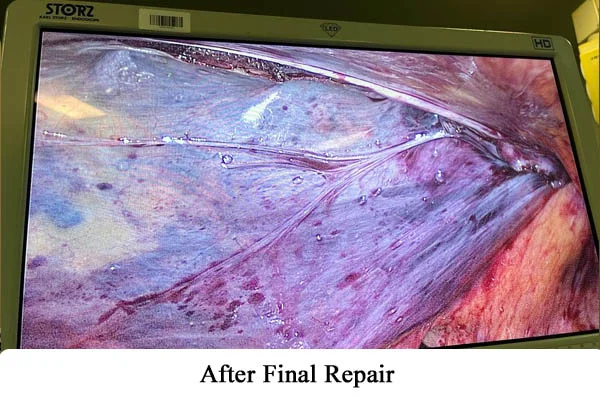 Hernia Repair by Robotics or by Laparoscopy