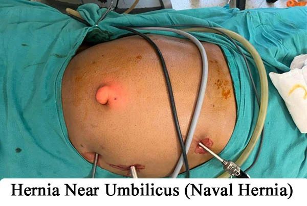 Hernia Repair by Robotics or by Laparoscopy