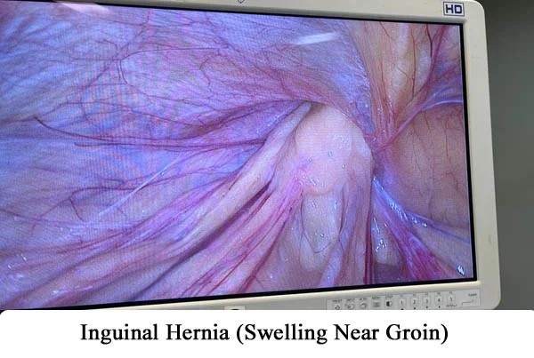 Hernia Repair by Robotics or by Laparoscopy