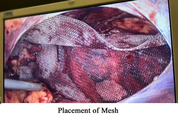 Hernia Repair by Robotics or by Laparoscopy
