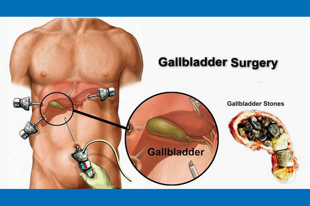 Laparoscopic Gallbladder Surgery