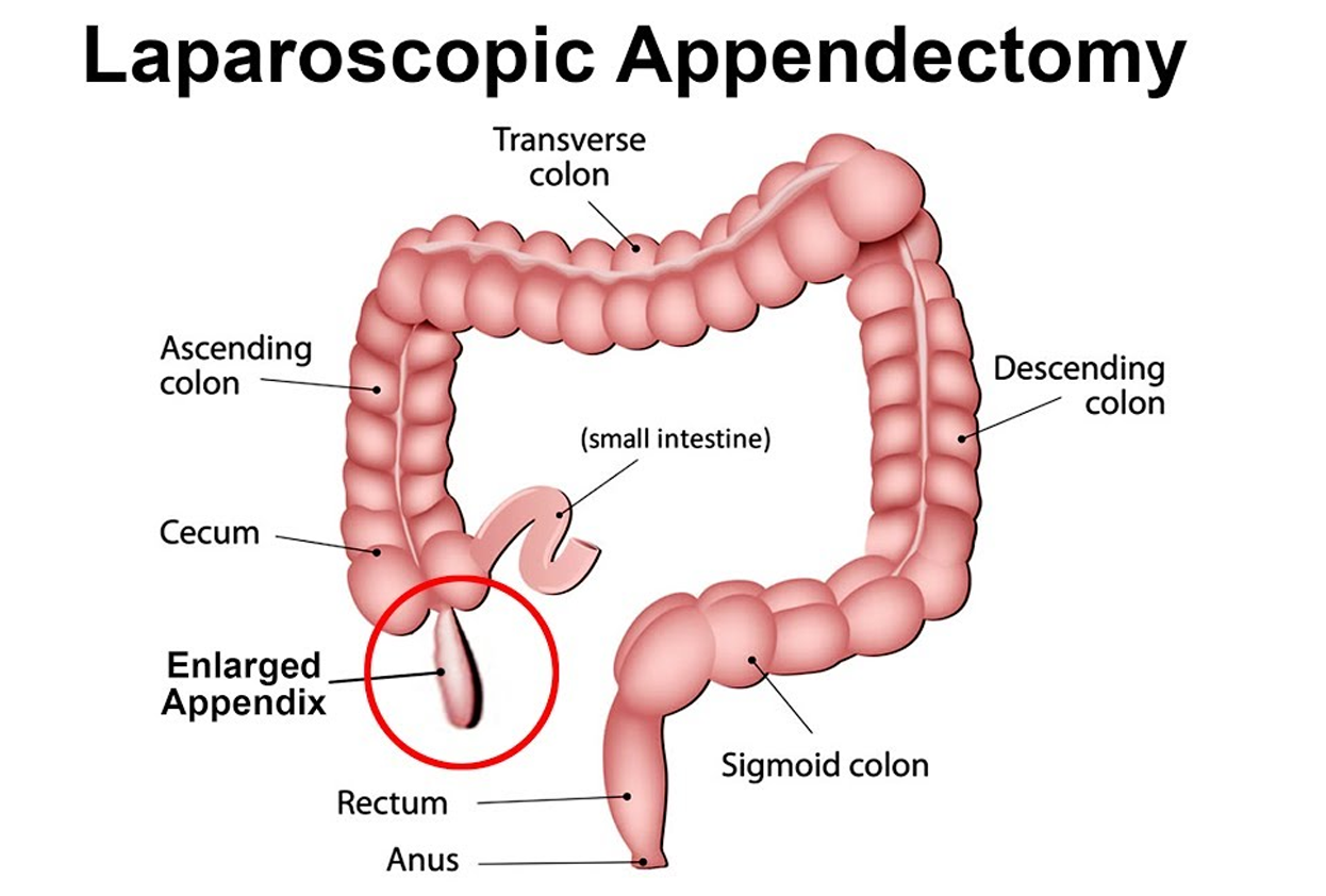 Laparoscopic Appendectomy