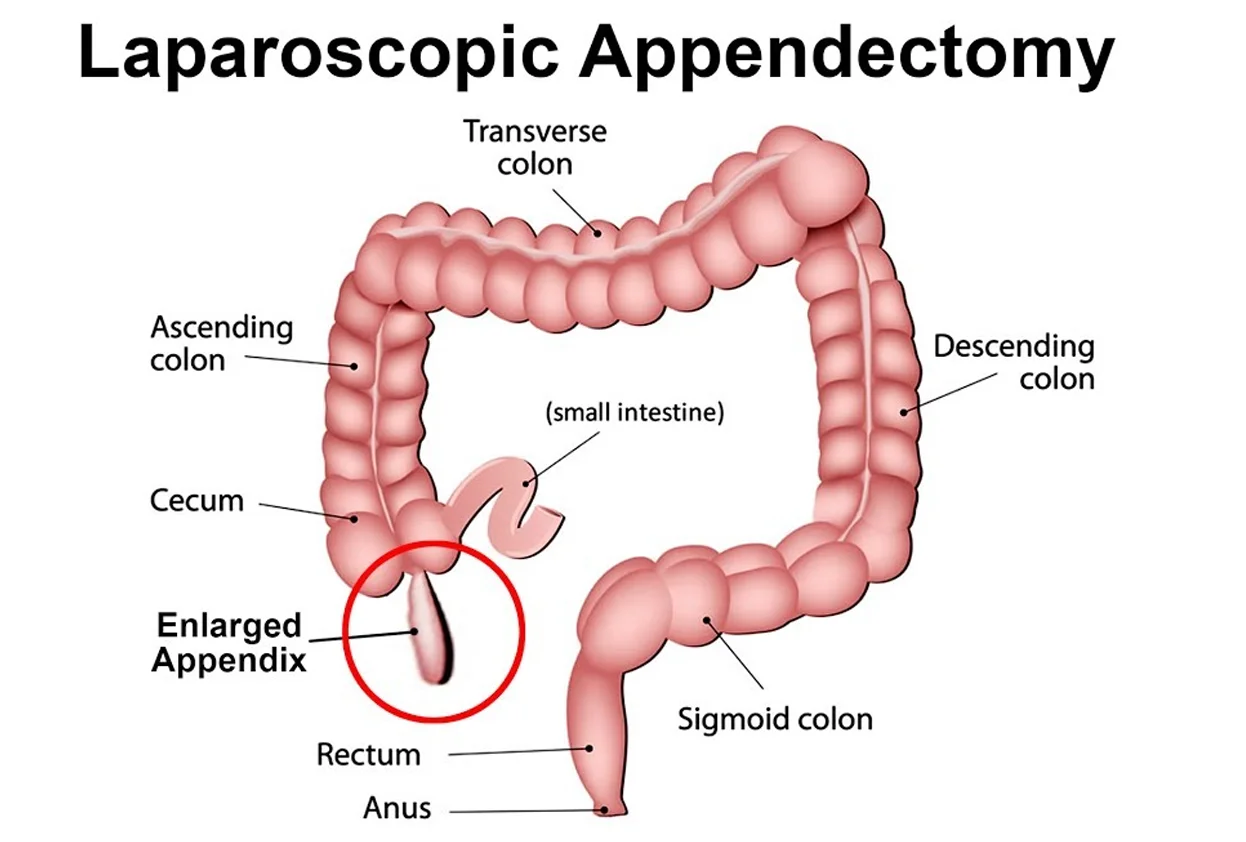 Laparoscopic Appendectomy