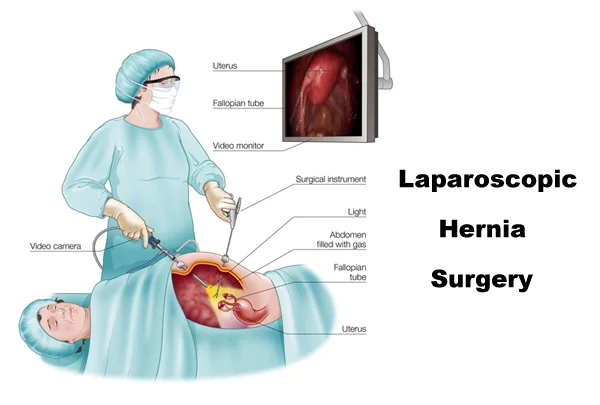 Laparoscopic Hernia Surgery