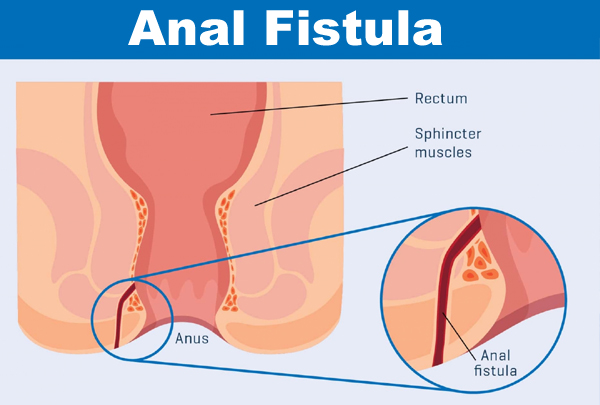 Laparoscopic Anal Fistula Surgery