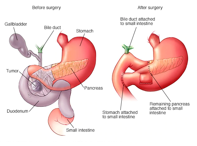 Laparoscopic Pancreas Surgery
