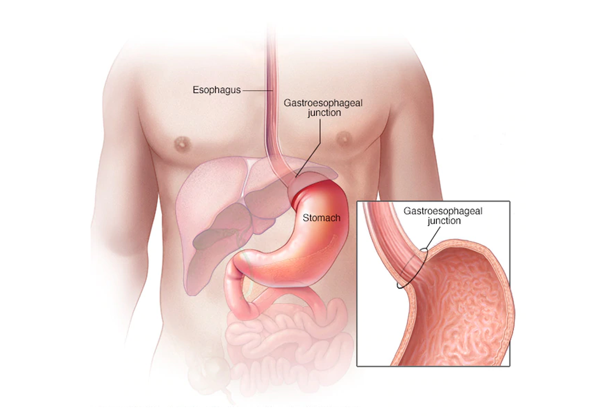 Stomach Cancer