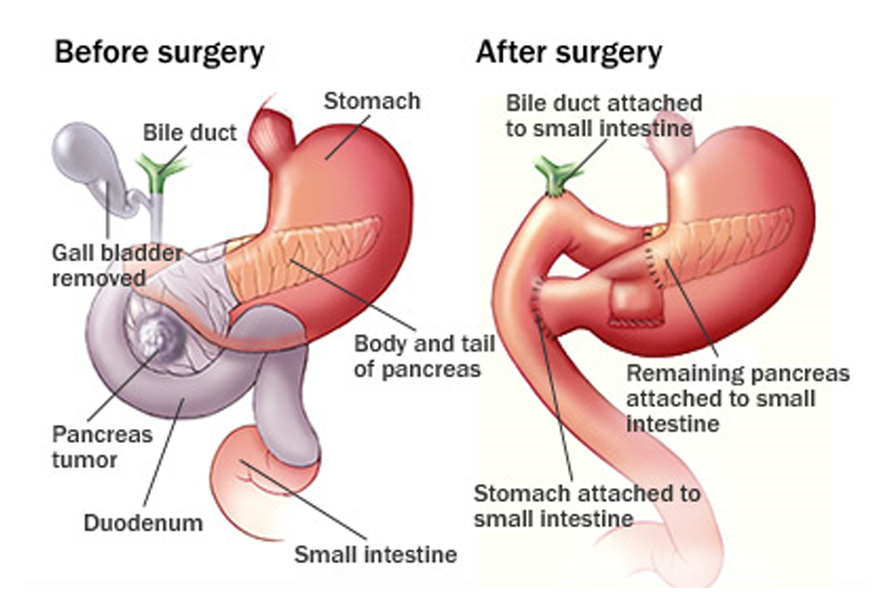 Pancreas Cancer