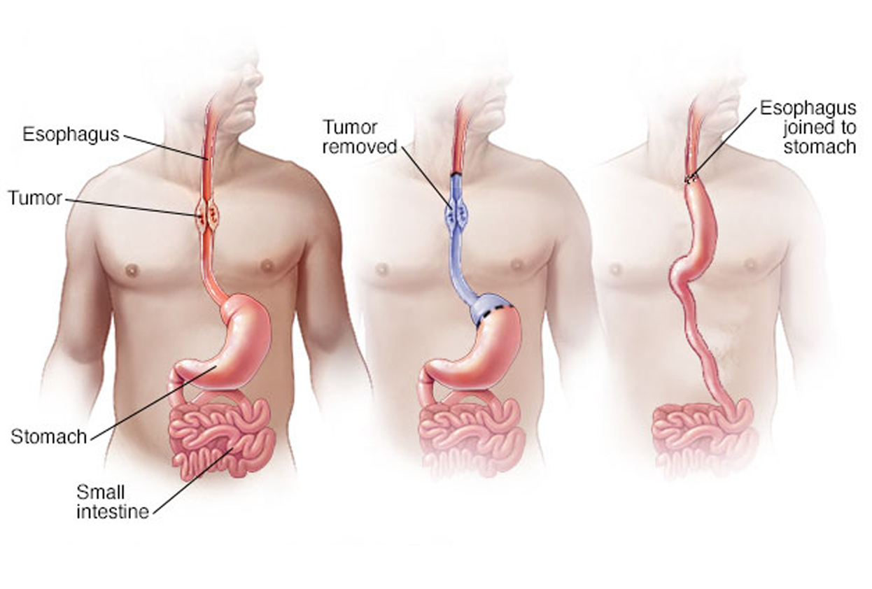 Esophagectomy (Cancer Esophagus)